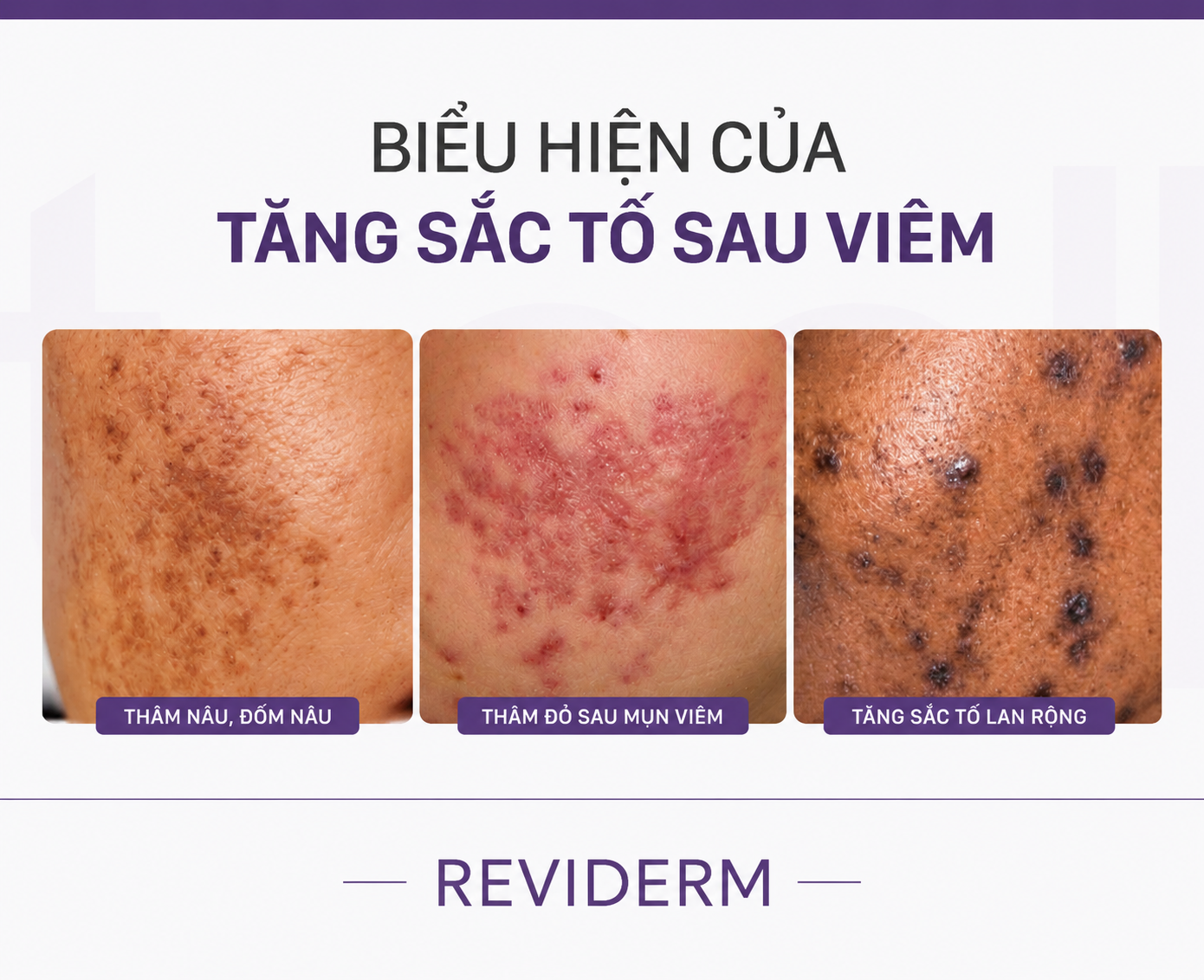 Việc soi da chuyên sâu sẽ giúp đánh giá chính xác nguyên nhân và mức độ sắc tố