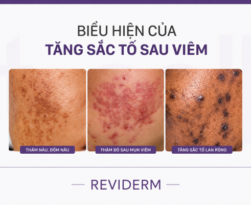 Biểu hiện của tăng sắc tố sau viêm