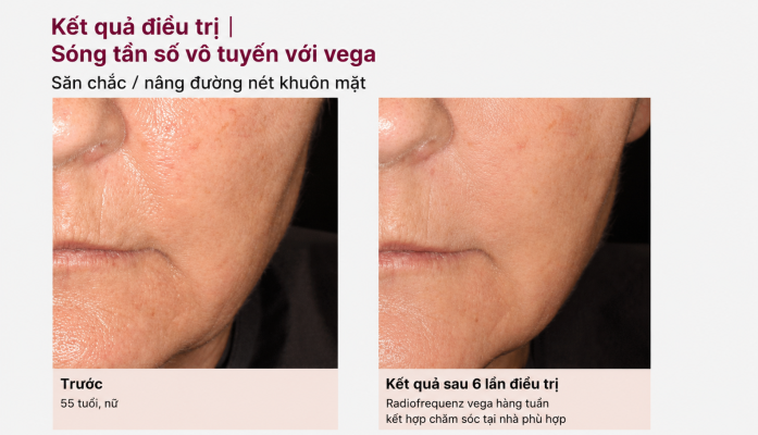 Hiệu quả của REVIDERM VEGA