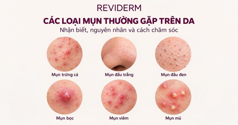 Cách dạng mụn thường gặp trên da